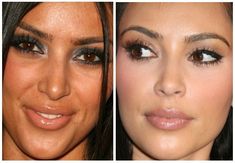 Ugly Noses, Kardashian Plastic Surgery, Kim Kardashian Before, Celebrities Before And After, Nose Job, Lip Fillers