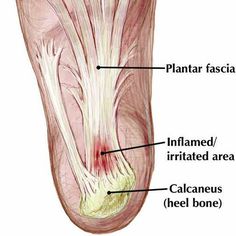 Plantar Facitis Wrapping, Plantar Fascia Relief, Facitis Plantar, Foot Pain Relief Remedies, Plantar Fascitis, Plantar Fascia, Pain Relief Remedies