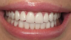 Crush Signs, Teeth Aesthetic, Pretty Teeth, Beautiful Teeth, Porcelain Veneers, Perfect Teeth, Wish Board, Smile Teeth, Smile Makeover