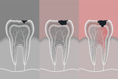 How to Deal with Sensitive Teeth Reverse Cavities, Wisdom Tooth Extraction, Dental Kids, Tongue Cleaner, Natural Toothpaste