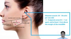 anatomical margins by cm for botox injections - Google Search Facial Fillers, Cosmetic Injectables, Facial Treatments, Botox Injections, Facial, Google Search