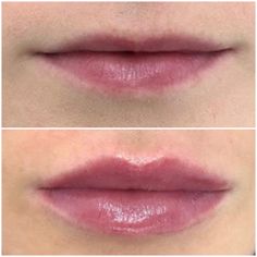 1ml Lip Filler, Im Worried, Juvederm Lips, Lips Inspiration, Botox Lips, Light Makeup Looks, Small Lips, Lip Filler