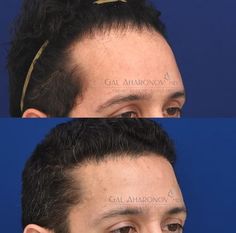 | HAIRLINE LOWERING SURGERY