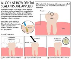 Dental Sealants Marietta Dental Appointment, Dental Insurance Plans, Pediatric Dental, Dental Cleaning, Dental Insurance