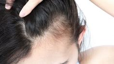 Perawatan Rambut Kering dan Mengembang Pada Umumnya Prp Hair, Hair Supplements, Best Hair Transplant, Boost Hair Growth, Regrow Hair, Home Remedies For Hair, New Hair Growth, Gabrielle Union, Hair Regrowth