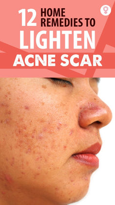 Learn some most effortless ways to minimize the appearance of those scars on your face. Treating Acne, Pimple Marks, How To Get Rid Of Acne, Style Mistakes, Hair Videos, Home Remedies, Natural Remedies, Surgery, Hair Hair