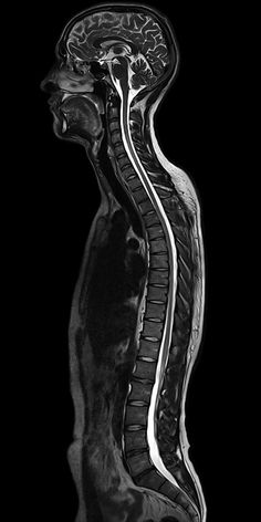 an x - ray image of the back of a person's head and neck