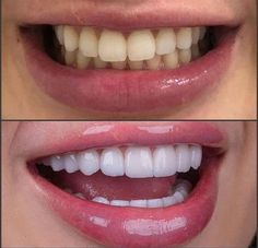 Get Whiter Teeth, Teeth Whitening Remedies, Bad Teeth, Teeth Whitening Diy, Porcelain Veneers