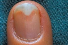 Nail Remedies, Split Nails, Nail Repair