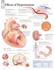 an image of the effects of hypertension on human heart and blood vessels poster