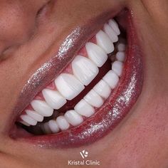 Teeth Goals, Perfect Teeth Smile, Teeth Aesthetic, Dental Mouthguards, Losing Teeth, Pretty Teeth, Veneers Teeth, Aesthetic Dentistry, Beautiful Teeth