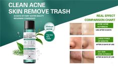 Moisturizing Toner, Aha Bha, Exfoliate Face, Remove Acne, Face Care, Tea Tree, Toner, Acne, Tea