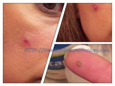 My hubby has always had issues with warts.  He’s tried most everything, but basically just continues on with them… On his feet, one on his leg and one on his hand…  Three months ago, I had a blemish on my face, it didn’t go away, and I am ashamed to say, I am a picker. … Diy Wart Removal Fast, Diy Wart Removal, Wart On Finger, Facial Warts, Warts On Hands, Skin Wars, Warts On Face, Warts Remedy, Wart Remover