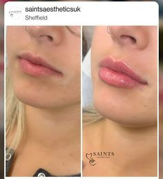 Lip Filler Round Face, Lip Styles Filler, Different Styles Of Lip Filler, Madison Beer Lips Before And After, Lip Goals Filler, Lip Filer Styles, M Shaped Lips Before And After, Lip Filler M Shaped Lips, Lip Filler Shapes Chart