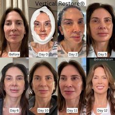 #plasticsurgery #plasticsurgerygonewrong #beforeafter #celebritiesbeforeafter #hollywoodstars #bignosesurgery #surgery #facesurgery #vlinesurgery #koreanplasticsurgery #kpopplasticsurgery #nosejob #jawreductionsurgery #eyesurgery #cheekfillers #rhinoplasty #facelift #plasticsurgeryfails #expensiveplasticsurgery Jaw Reduction Surgery, Face Procedures, Korean Plastic Surgery, Unusual Beauty, Face Surgery, Aesthetic Dermatology, Face Lift Surgery