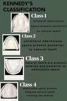 Dentistry Notes, Dental Prosthesis, Dental Nurse, Registered Dental Hygienist