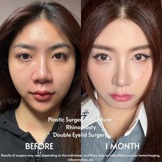 For more information: ❤️Whatsapp: +82-10-2103-7174 💛Kakao: viewinquiry 💚LINE: viewinquiry ✉️E-mail: eng_viewps@viewclinic.com 💎Website: www.viewplasticsurgery.com