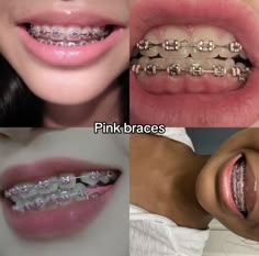 Cute Color Braces Ideas, Light Pink Braces Aesthetic, Braced Teeth, Braces Inspo Colors, Clear Braces With Color Bands, Light Pink Braces, Hot Pink Braces