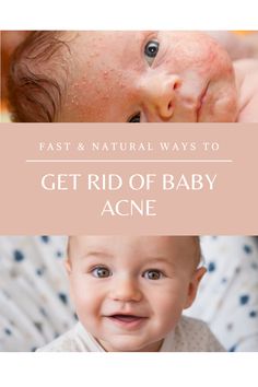 two babies with the words get rid of baby acne