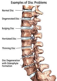 Massage Logo, Inversion Table, Bulging Disc