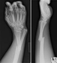 an x - ray image of the right hand and left arm