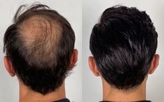 Hair Pieces For Men, Men Wigs, Hair Transplant Ads, Wigs For Men, Hair Transplant Before And After Men, Hair Transplant Before And After Turkey, Before And After Hair Transplant, Hair Transplant Procedure, Hair Unit