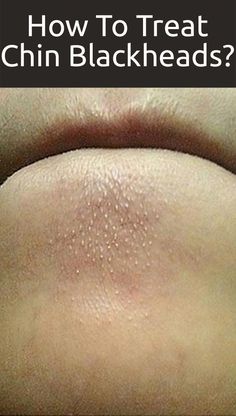 Blackheads on chins can be annoying to deal with. Read to know more about the different causes and home remedies you can use to treat blackheads on your chin. Chin Whiteheads, Chin Blackheads, Clear Blackheads, Black Heads, Beauty Remedies, Natural Home Remedies, Skin Tips