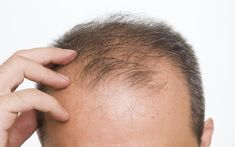 Do Laser Caps Work? Hair Transplant Surgery, Hair Supplements, Best Hair Transplant, Regrow Hair, Hair Raising, Hair Replacement, Cornrow, Hair Growth Tips, Hair Restoration