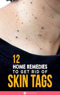 You don’t need expensive cosmetic surgeries for skin tag removal. Instead, try these natural home remedies for skin tags to manage them. Click to learn more. Cursed Doodles, Natural Remedy For Cough, Skincare At Home, Coconut Oil Skin, Natural Remedies For Cough, Home Remedies For Cold, Home Remedies For Skin