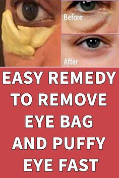 Remove puffiness easily with this simple formula. Click on the image to see the recipe details Remove Eye Bags, Wrinkle Free Skin, Eye Vitamins, Forehead Wrinkles, Face Wrinkles