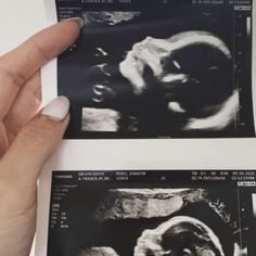 a person holding up an x - ray image in their left hand, and another photo on the right