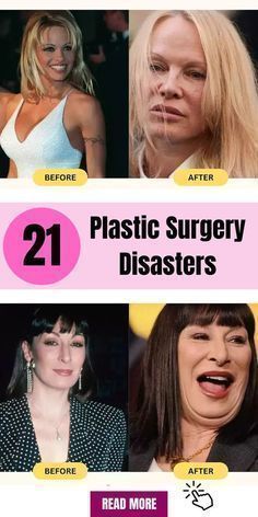 four different pictures of women with plastic surgery on their faces and the words, 21 plastic surgery