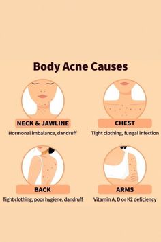 Skin Advice, Natural Face Skin Care, Acne Causes, Body Acne