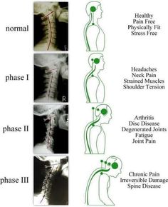 Punkty Spustowe, Spinal Degeneration, Text Neck, Spine Health, Medical Anatomy, Neck And Back Pain, Chiropractic Care