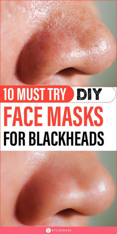 10 Must Try DIY Face Masks For Blackheads : Blackheads are a mild form of acne.They are formed when your skin pores are clogged due to the oversecretion of oil and sebum. If you don’t know where to begin, we have a list of DIY blackhead removal mask recipes for you. Take a look! #skincare #beauty #blackheads #acne #skinacne #diy #facemasks
 ... less Face Masks For Blackheads, Mask For Blackheads, Masks For Blackheads, Removing Blackheads, Natural Remedies For Cough, Face Mask For Blackheads, Cold Sore Remedies, Black Head Remover Mask, Home Remedies For Cold