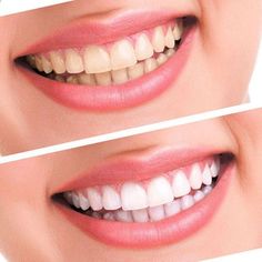 gentle dental care Dental Bleaching, Best Teeth Whitening Kit, Teeth Whitening Homemade, Teeth Whitening Remedies, Teeth Whitening Toothpaste, Laser Teeth Whitening, Charcoal Teeth Whitening, Teeth Bleaching, Teeth Whitening System