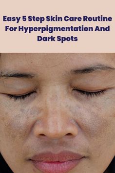 Treating hyperpigmentation became this easy with these 5 skin care steps. Here's how!
#pigmentation #darkspot #skincareroutine #unevenskintone Dark Patches On Face, Face Hyperpigmentation, Skin Care Hyperpigmentation, Acne Overnight, Treating Hyperpigmentation, Oily Skin Acne, Face Routine