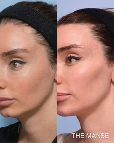 Cheek fillers before and after: Sydney dermal filler clinic Aesthetic Before And After, Check Filler Before And After, Cheek Fillers Before And After, Cheek Filler Before And After, Cheekbone Filler, Fillers Before And After