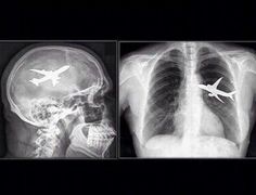 an x - ray shows two different views of the lungs