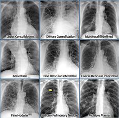 multiple images of the chest showing different types of lunges and their corresponding functions in each region