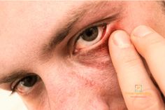 A stye (hordeolum) is a reddish bump, kind of like a pimple, which forms on the exterior border of the anus. Stye Remedy, Eye Stye Remedies, Forehead Acne, Irritated Eye, Eye Infections, Eyes Problems, Dry Eyes, Eye Health, Warm Water