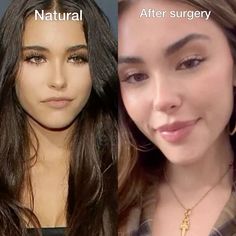 Madison Beer lip filler, face lift, eyebrow lift, canthoplasty (foxy eye surgery) eyebrow lift; Botox, lip flip, alarplasty (nose job) jaw/chin fillers and implants, cheek fillers Jaw Surgery Before And After, Worst Makeup, Eyebrow Lift