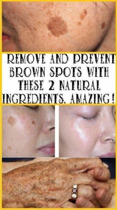 Get Rid Of Age Spots, Sun Spots On Skin