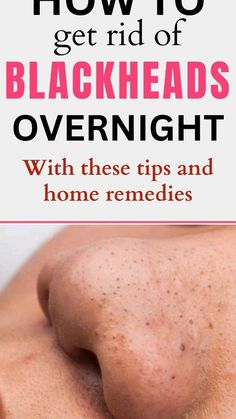 Remedy For Blackheads, Nose Blackheads, How To Remove Blackheads, For Blackheads, Blackhead Remedies, To Remove Blackheads, Blackheads On Nose, Rid Of Blackheads, Skin Natural Remedies