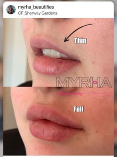 Lip Filler Bottom Lip Bigger, Lip Filler Downturned Lips, Lip Fillers Round, Pillow Lips Injections, Lip Injection Inspiration, Angelic Lip Filler, Lip Filler Shape Ideas Pouty, Lip Fillers Before And After 1ml Russian, M Shaped Lips With Filler