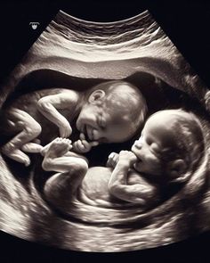 an image of two babies in the middle of their stomach