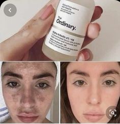 Ordinary Serum, The Ordinary Alpha Arbutin, Ordinary Skincare, Ordinary Products, Get Rid Of Acne, Rid Of Acne, Serious Skin Care, Basic Skin Care Routine