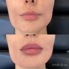 Russian Lips Filler Before And After, Bad Lip Filler, Russian Lip Filler Technique, Lip Fuller, Russian Lip Filler, Facelift Makeup