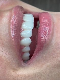 Grow Back Receding Gums, Whiten Teeth Fast, Teeth Aesthetic, Teeth Whitening At Home, Pretty Teeth, Heal Cavities, Veneers Teeth, Teeth Whitening Diy, Beautiful Teeth