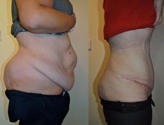 Lipectomie abdominale,chirurgie plastique et esthétique du ventre.Lire ce qu'il faut savoir avant d'envisager cette chirurgie. Plus Size Tummy Tucks Before And After, Tummy Tucks Before And After, Body Lift Surgery, Tummy Tucks Recovery, Skin Removal Surgery, Body Contouring Surgery, Celebrity Plastic Surgery, Breast Reduction